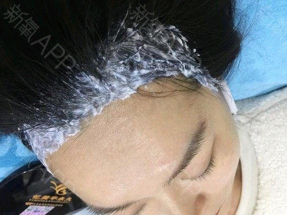 半永久紋發(fā)際線