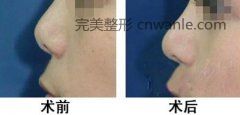 做完鼻尖整形手術(shù)后的護(hù)理事項(xiàng)