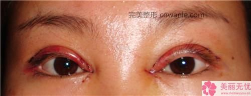 鼻尖整形術(shù)5種鼻尖狀況的矯正方法