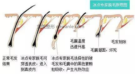 冰點(diǎn)脫毛比激光脫毛會(huì)有何優(yōu)勢(shì) 激光脫毛和冰點(diǎn)脫毛有何區(qū)別
