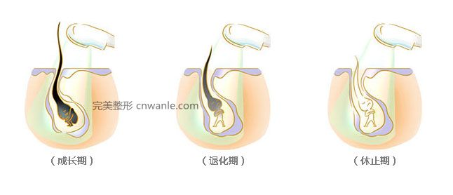 脫毛過程