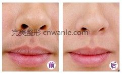冰點(diǎn)脫毛幾個(gè)月會(huì)長(zhǎng)出來