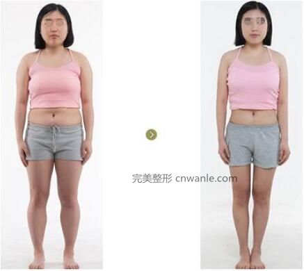 大腿<a href='/tag_xizhijianfei25.html'>吸脂減肥</a>手術會不會反彈呢