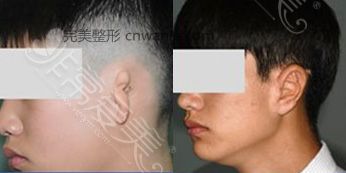 韓國(guó)BIO小耳癥矯正效果對(duì)比