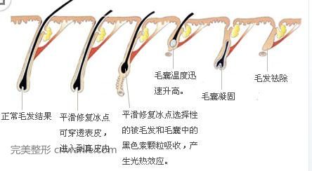 冰點(diǎn)脫毛 錦州冰點(diǎn)脫毛 錦州冰點(diǎn)脫毛怎么樣