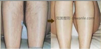 冰點(diǎn)脫毛幾個(gè)月會(huì)長(zhǎng)出來