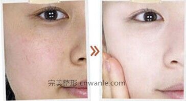 冰點(diǎn)脫毛的副作用