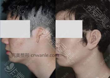 BIO整形外科小耳癥矯正前后對(duì)比圖