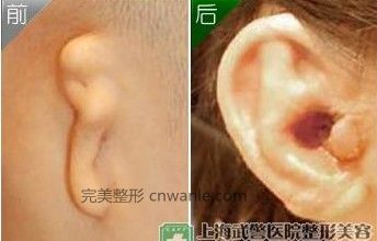 耳朵再造手術前后對比圖