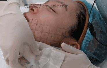 電波拉皮