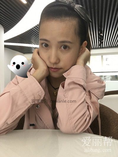 <a href='/tag_fajixianzhongzhi.html'>發(fā)際線種植</a>效果好嗎？案例分享