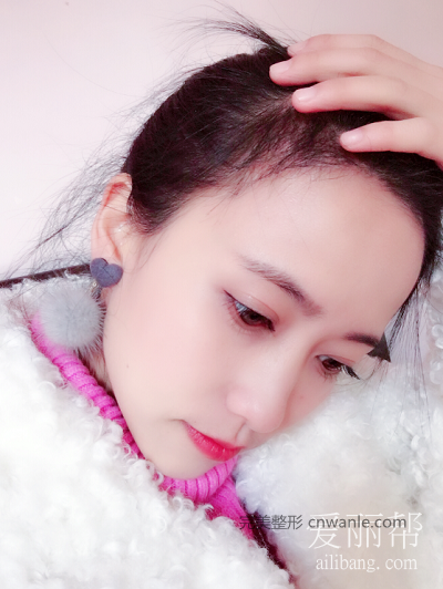 發(fā)際線種植效果好嗎？案例分享