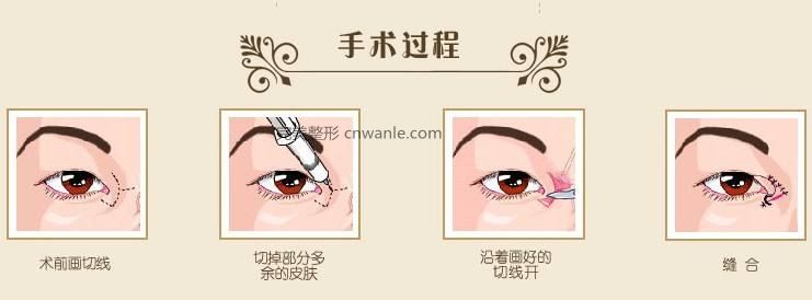<a href='/tag_kaiyanjiao68.html'>開(kāi)眼角</a>