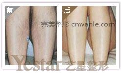 成都藝星激光脫腿毛會(huì)痛嗎