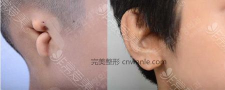韓國(guó)普羅菲耳小耳癥矯正效果對(duì)比圖