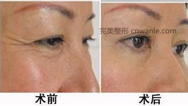 電波拉皮后的實(shí)際效果怎么樣