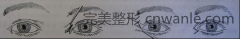 華西開眼角會留疤嗎？