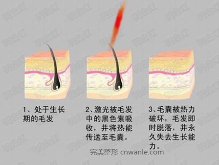 冰點脫毛