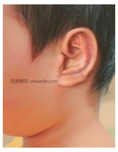 肋軟骨耳再造三期修復(fù)術(shù)