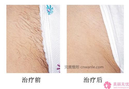 冰點脫毛有哪些優(yōu)勢_冰點脫毛的優(yōu)點有哪些