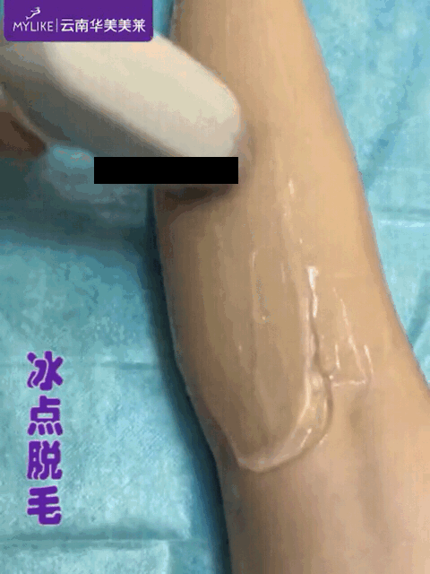冰點脫毛