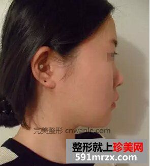 <a href='/tag_feishoushulongbi2.html'>非手術(shù)隆鼻</a>+鼻尖肥大整形 御姐范十足