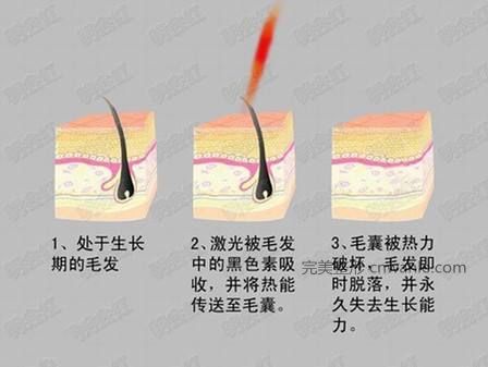 冰點脫毛