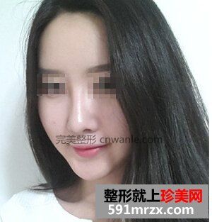 非手術(shù)隆鼻+鼻尖肥大整形 御姐范十足