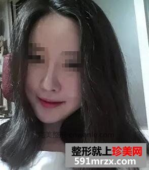 做了隆鼻和<a href='/tag_bijianzhengxing10.html'>鼻尖整形</a> 感覺(jué)鼻子很漂亮