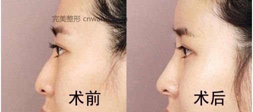 鼻尖整形手術(shù)要多少錢