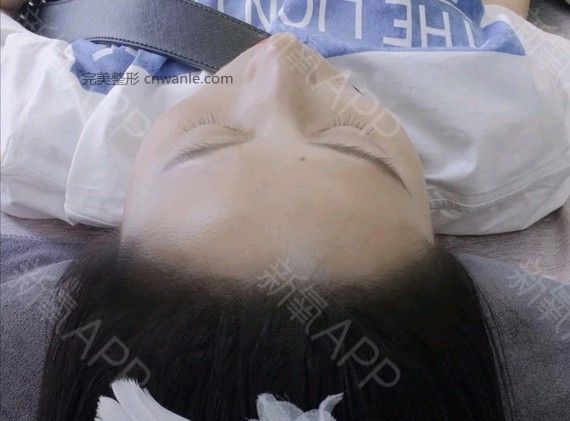 半永久紋發(fā)際線