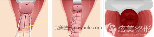 Miss陰道整形手術(shù)韓國好手藝婦科