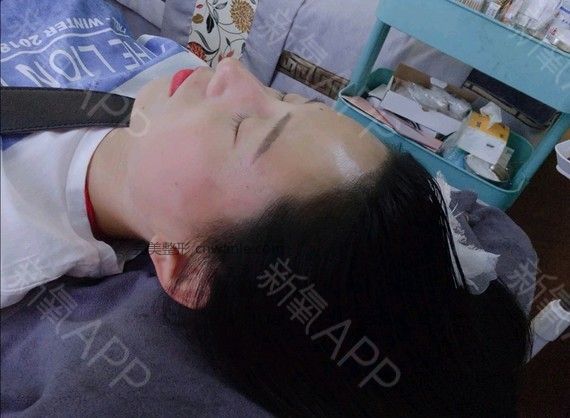 半永久紋發(fā)際線