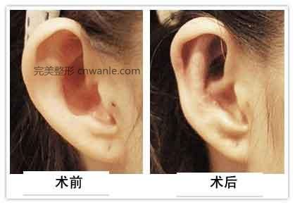 耳廓整形手術(shù)要注意什么
