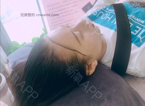 半永久紋發(fā)際線