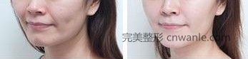 電波<a href='/tag_lapi2.html'>拉皮</a>