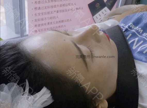 半永久紋發(fā)際線
