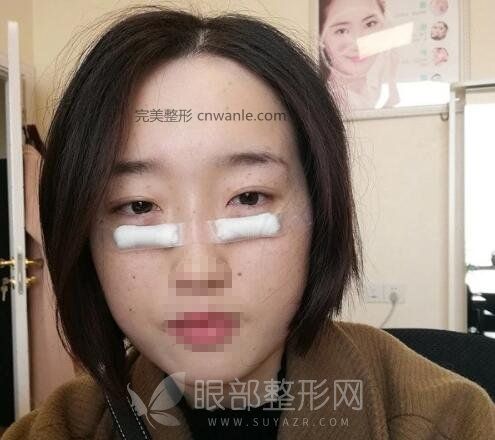 電波拉皮去眼袋效果太好了吧！這是什么神仙技術(shù)！
