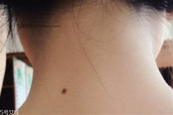 脖子后面有痣好嗎？激光冷凍祛痣易導(dǎo)致癌變