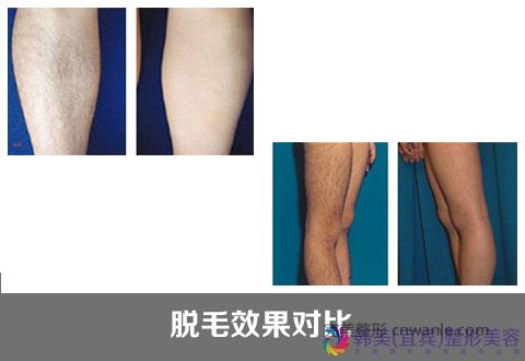 冰點(diǎn)脫毛優(yōu)勢(shì)大攻略