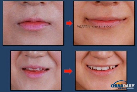 近幾個月來，一種被稱為“Smile Lipt”的嘴角<a href='/tag_zhengrong3.html'>整容</a>手術(shù)在韓國非常風(fēng)靡。該手術(shù)將嘴角切開再縫合，重新調(diào)整上下顎的角度，使得嘴部的線條更柔和。