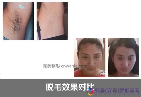 冰點(diǎn)脫毛的優(yōu)勢有哪些?冰點(diǎn)脫毛 冰點(diǎn)脫毛的優(yōu)勢有哪些?冰點(diǎn)脫毛