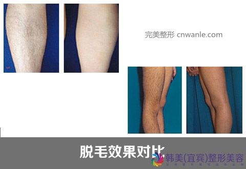 冰點脫毛優(yōu)勢是什么