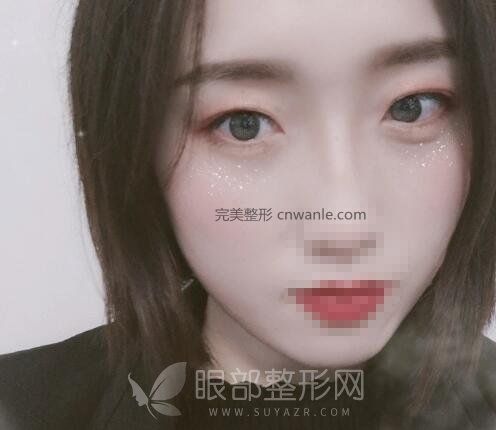 電波拉皮<a href='/tag_quyandaishu.html'>去眼袋術(shù)</a>前術(shù)后對比