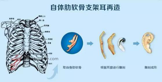 耳畸形_耳再造_肋軟骨造耳_中整協(xié)耳再造救助修復(fù)基地
