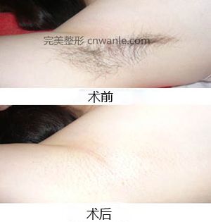 冰點(diǎn)無(wú)痛脫毛優(yōu)勢(shì)是什么?