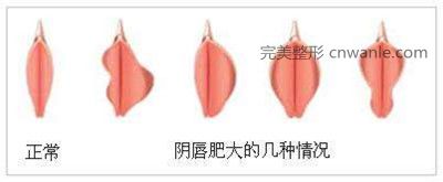 韓國陰唇整形多少錢