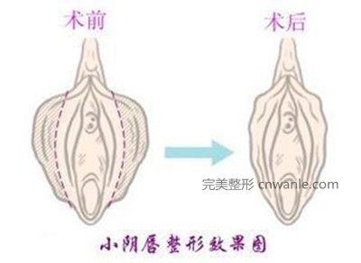 韓國好手藝陰唇<a href='/tag_zhengxingshoushu5.html'>整形手術</a>對比