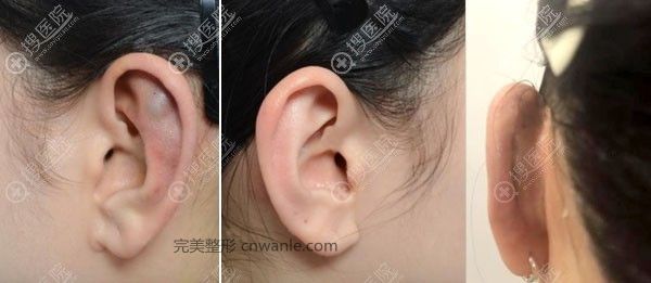 韓國(guó)普羅菲耳招風(fēng)耳矯正術(shù)后2周恢復(fù)圖