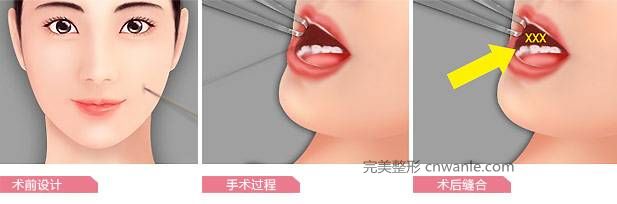 酒窩整形手術(shù)怎么做